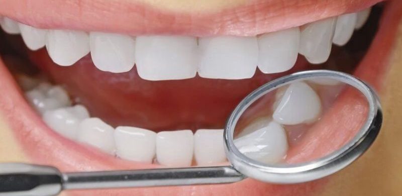 Restavratsiya-zubov-kompozitnyim-materialom